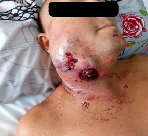 E:\CIRUGÍA MAXILOFACIAL\rey\Fascitis nerotizante\Figura 1.jpg