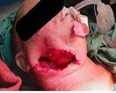 E:\CIRUGÍA MAXILOFACIAL\rey\Fascitis nerotizante\Figura 2.jpg