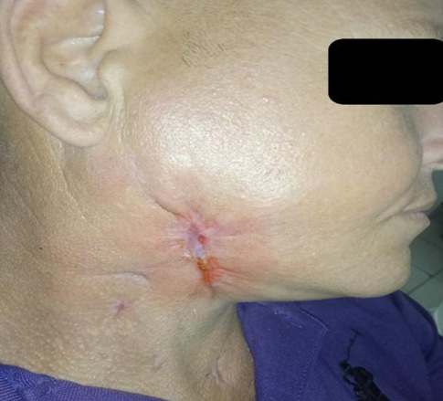 E:\CIRUGÍA MAXILOFACIAL\rey\Fascitis nerotizante\Figura 3.jpg
